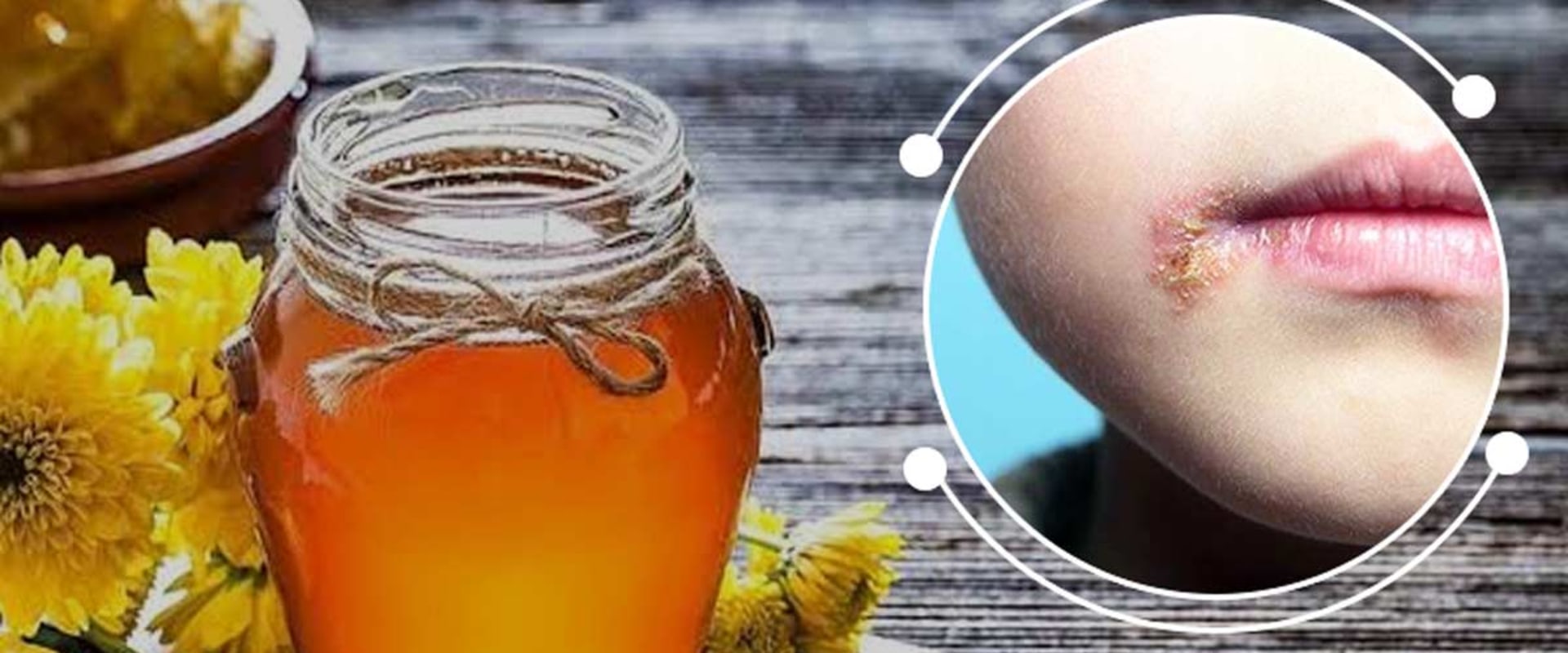 Ayurveda and Herpes: An Alternative Treatment Overview