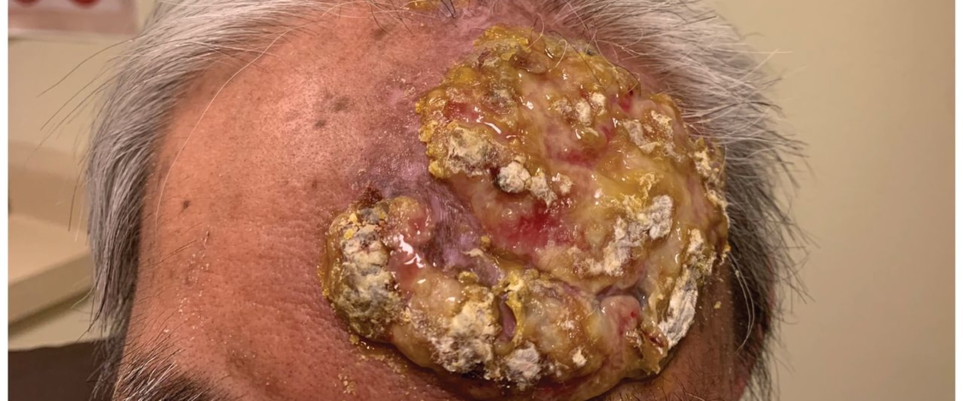 Valacyclovir Cream for Herpes: A Comprehensive Overview