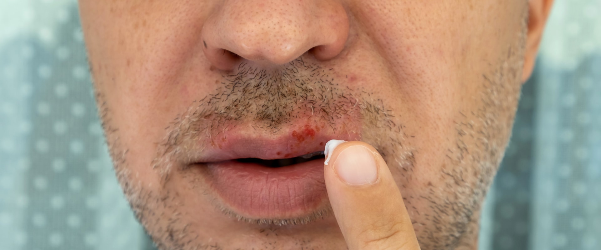 Acyclovir Cream to Treat Herpes
