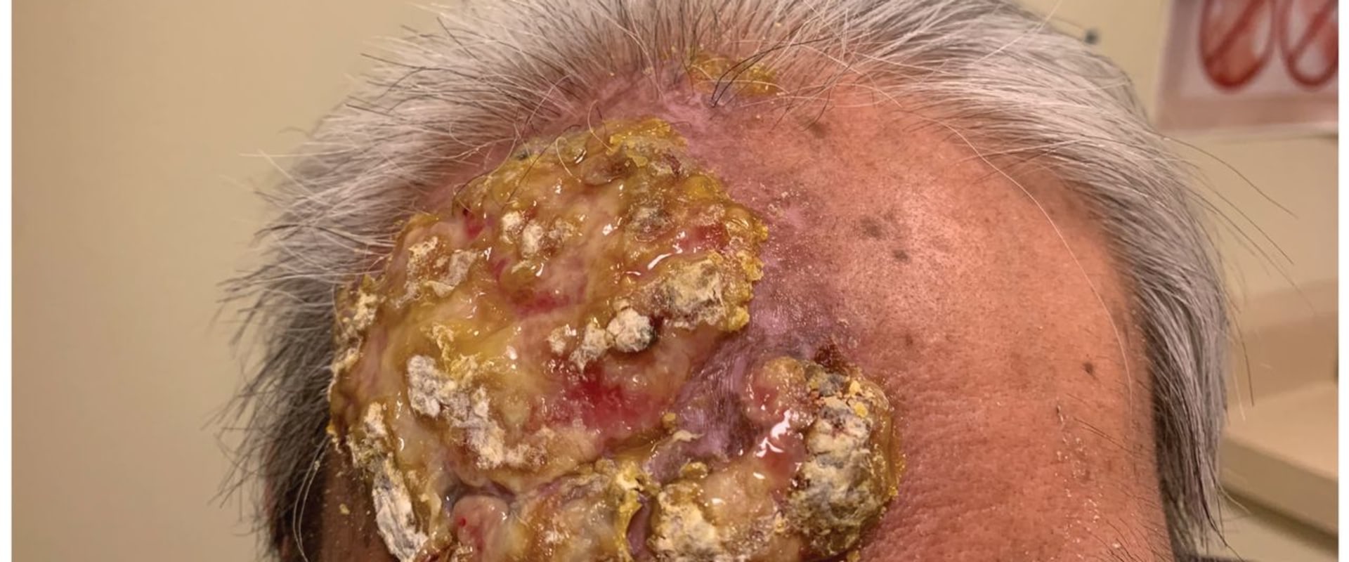 Valacyclovir for Herpes: A Comprehensive Overview