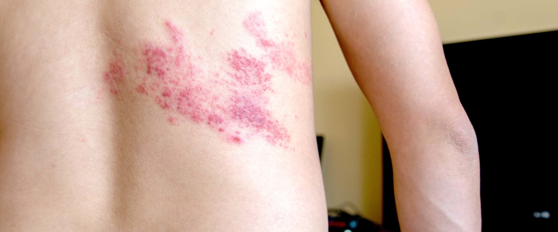 Famciclovir Cream for Treating Herpes