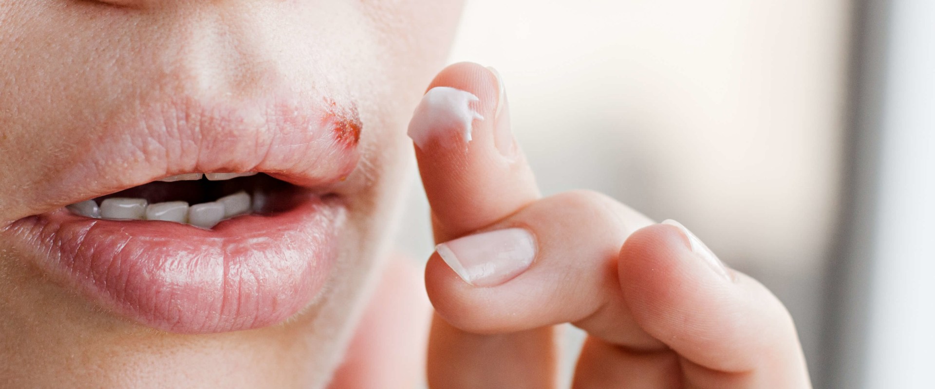 Acyclovir for Herpes: An Overview