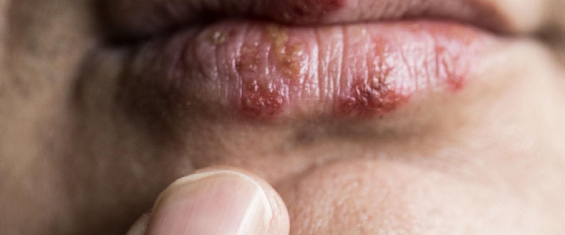 Valacyclovir Cream for Herpes: All You Need to Know
