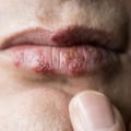 Valacyclovir Cream for Herpes: All You Need to Know